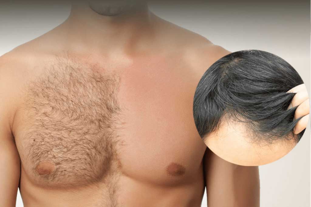 Body Hair Transplant In Turkey AEK Hair Clinic