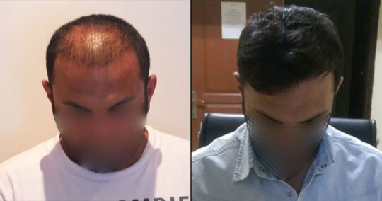 Hair Transplant Before and After 2200 Graft 5000 Hair