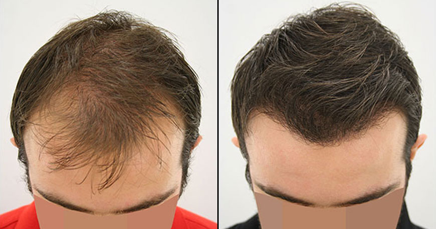 Hair transplant Turkey Before After – Cosmedica - DrAcar