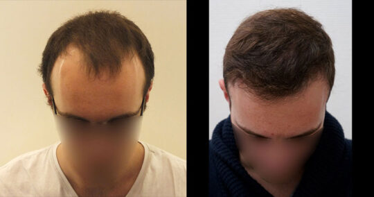 Hair Transplant Turkey Before and After Photos 2023 | AEK Hair Clinic