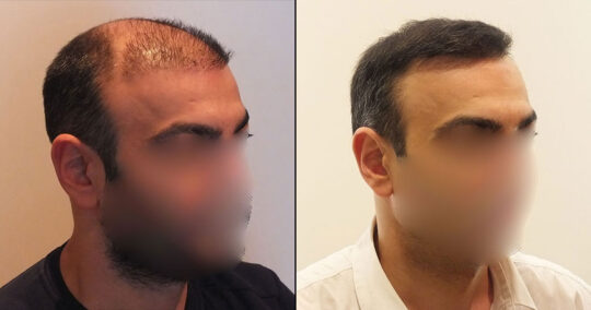 Hair Transplant Before and After 5700 Graft 12000 Hair