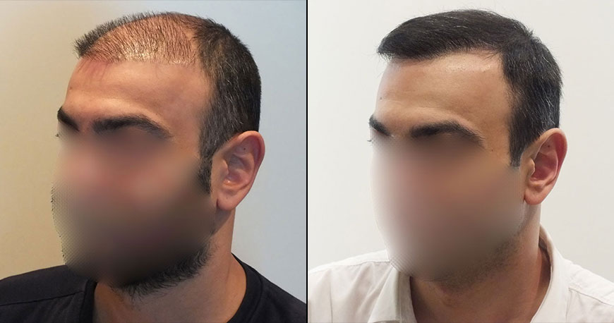 Hair Transplant Before and After 5700 Graft 12000 Hair | AEK Hair Clinic